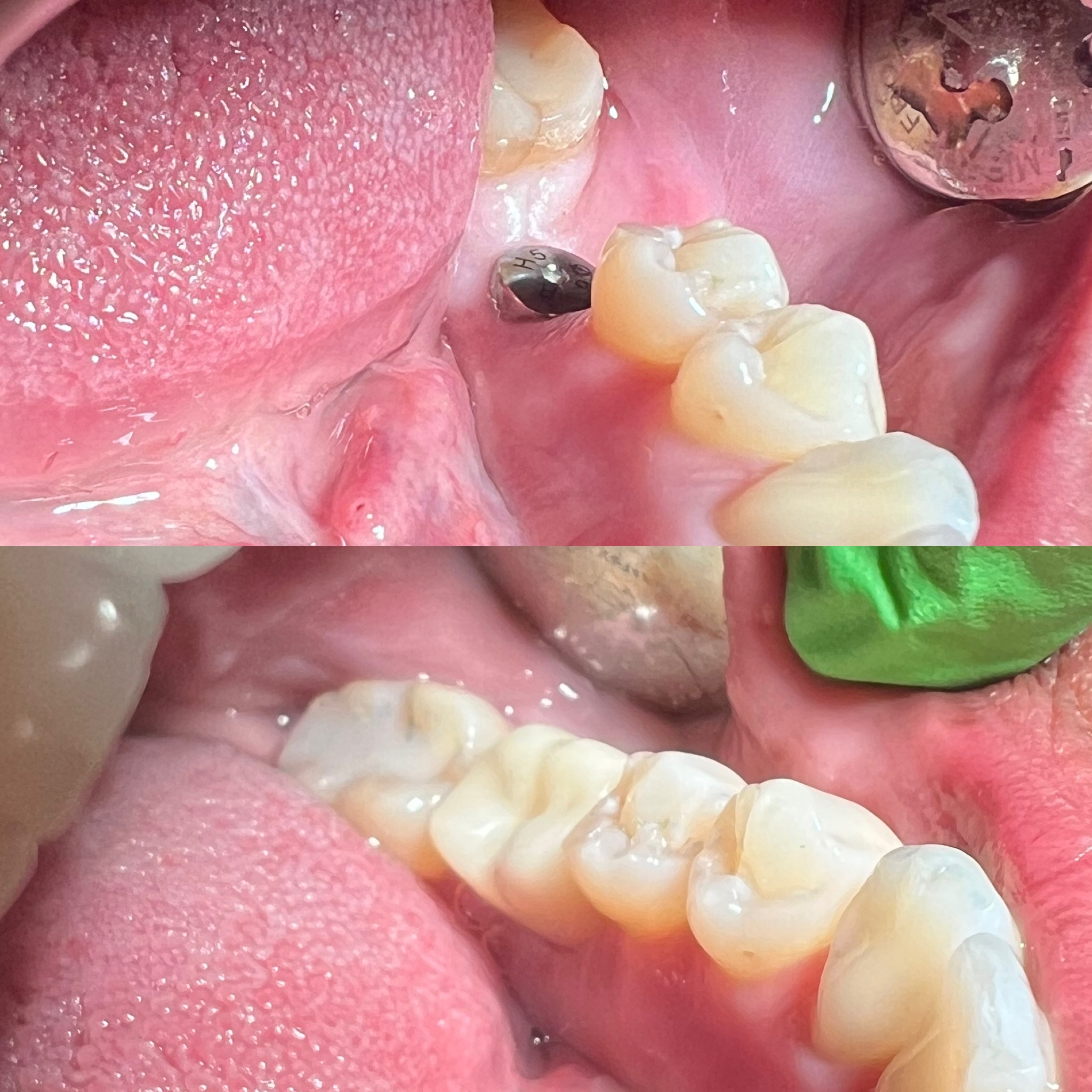 Two Stage Implant Placement and Restoration
